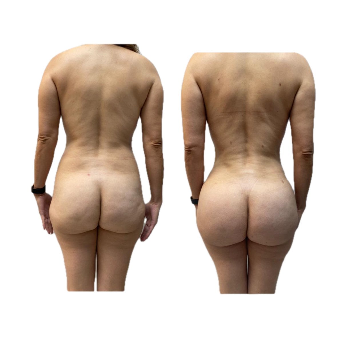 Resultados antes y después de Brazilian Butt Lift en Hospital de la Familia, glúteos realzados