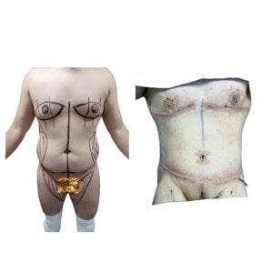 Before and after tummy tuck results at Hospital de la Familia, male abdominal contouring