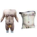 Before and after tummy tuck results at Hospital de la Familia, male abdominal contouring