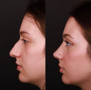 Vorher-nachher-Ergebnis der Spitzenrhinoplastik in Medipol Acibadem District Hospital