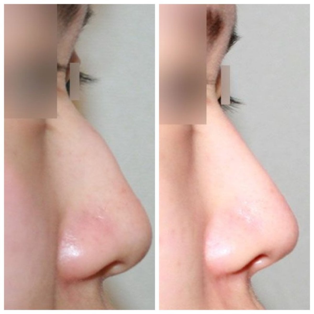 Resultados de rinoplastia antes y después en HERSHE Plastic Surgery Korea, perfil mejorado