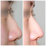 Before and after rhinoplasty results at HERSHE Plastic Surgery Korea, improved nose profile