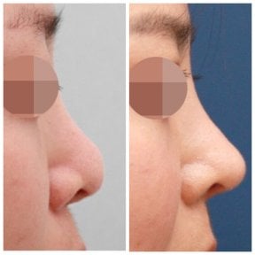 Before and after rhinoplasty results at HERSHE Plastic Surgery Korea, improved nose profile