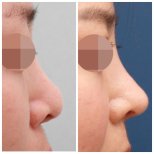Before and after rhinoplasty results at HERSHE Plastic Surgery Korea, improved nose profile