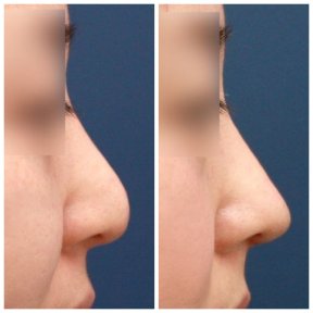 Before and after rhinoplasty results at HERSHE Plastic Surgery Korea, improved nose profile