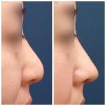 Before and after rhinoplasty results at HERSHE Plastic Surgery Korea, improved nose profile