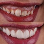 Before and after Hollywood Smile results at Estemarley – dental veneers for perfect teeth