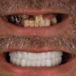 Before and after Hollywood Smile results at Estemarley – full dental restoration and whitening