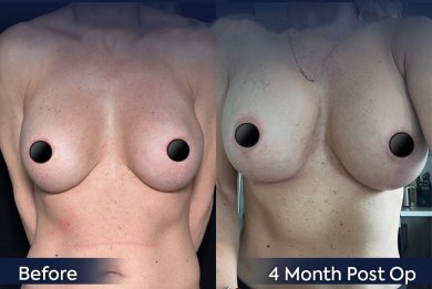 Before and after breast implant removal results at Dr. Safa Manav Clinic, 4 months post-op
