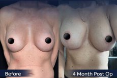 Before and after breast implant removal results at Dr. Safa Manav Clinic, 4 months post-op