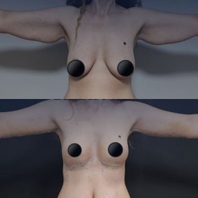 Before and after arm lift (brachioplasty) results at Dr. Safa Manav Clinic, improved arm contour