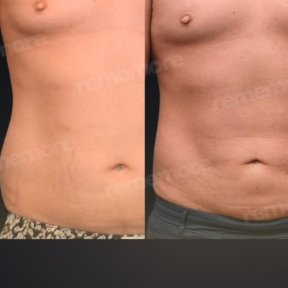 Vorher-nachher-Ergebnis 360°-Liposuktion bei Memorial Göztepe Hospital, verbesserte Körperkontur