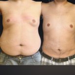 Vorher-nachher-Ergebnis 360°-Liposuktion bei Memorial Göztepe Hospital, verbesserte Körperform