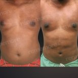 360-Liposuktion Vorher-Nachher-Ergebnisse bei Memorial Göztepe Hospital, verbesserte Körperkontur