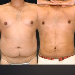 360-Liposuktion Vorher-Nachher-Ergebnisse bei Memorial Göztepe Hospital, verbesserte Körperkontur