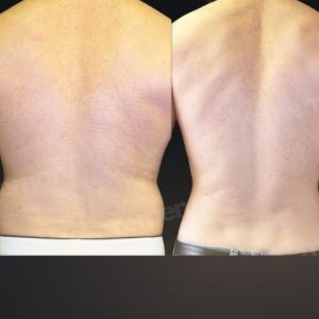 360-Liposuktion Vorher-Nachher-Ergebnisse bei Memorial Göztepe Hospital, verbesserte Rückenform