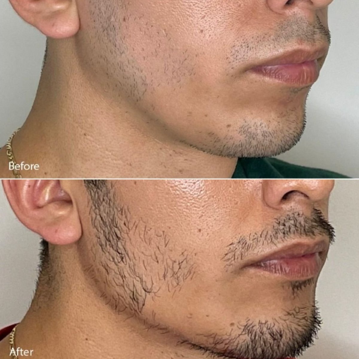 نتائج زراعة اللحية قبل وبعد في عيادة TIAM Aesthetic Clinic، نمو شعر الوجه المحسن