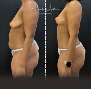 Before and after tummy tuck results at Alexandra Aguilera clinic, visible abdominal contour