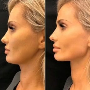 Before and after buccal fat extraction at CE International Hospital, defined cheek contour result