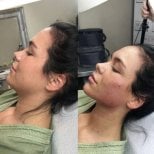 Before and after buccal fat extraction at CE International Hospital, slimmer facial contour result