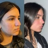 Before and after buccal fat extraction at CE International Hospital, slimmer facial contour result