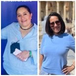 Before and after gastric bypass results at Dr. Enrique Pliego Private Practice, weight loss visible