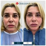 Фото до та після видалення грудок Біша, доктор 