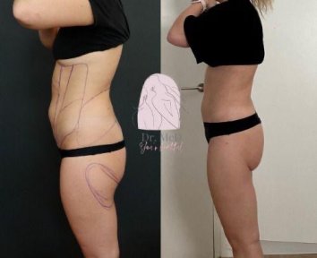Before and after abdominal liposuction results at Dr. MED – slimmer waist and flat stomach