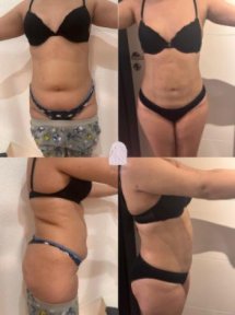 Before and after abdominal liposuction results at Dr. MED – visible waist contour improvement
