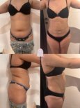 Before and after abdominal liposuction results at Dr. MED – visible waist contour improvement