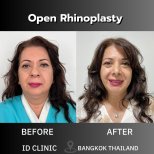 Fotos de antes y después de Rinoplastia tomadas por el Dr.(la Dra.)