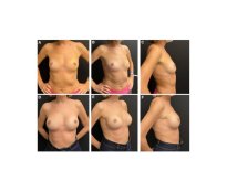 Fotos de antes y después de Aumento de pecho tomadas por el Dr.(la Dra.) 