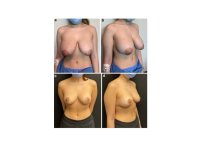 Fotos de antes y después de Aumento de pecho tomadas por el Dr.(la Dra.) 