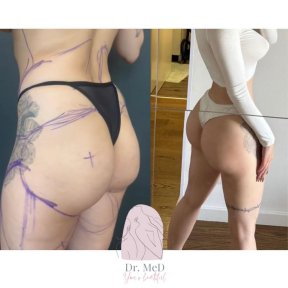 Before and after Brazilian Butt Lift results at Dr. MED, enhanced curves and contour