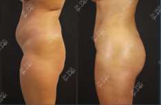 Before and after Brazilian Butt Lift results at Dr. MED – enhanced curves and lifted buttocks