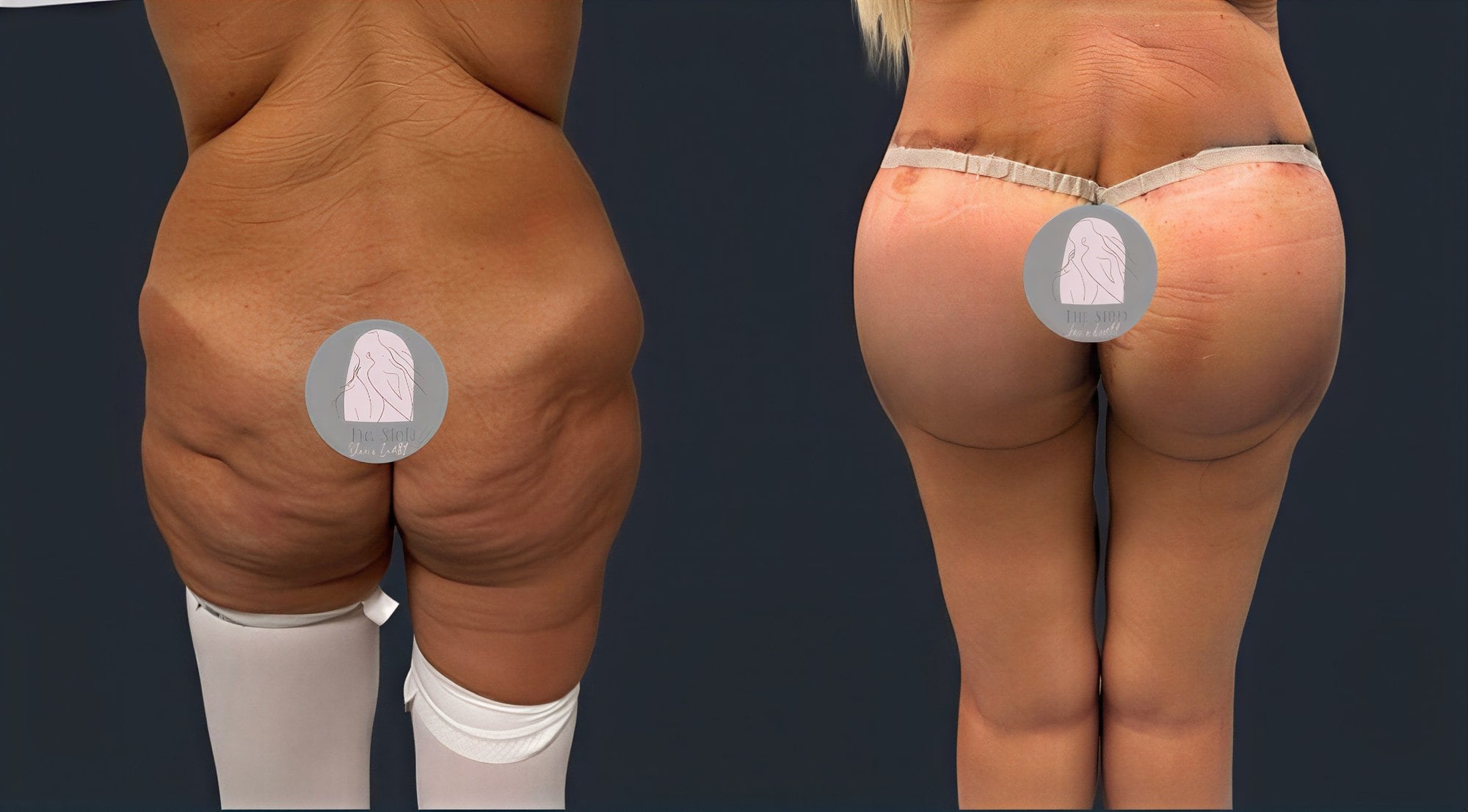 Resultados antes y después de Brazilian Butt Lift en Dr. MED – glúteos mejor contorneados