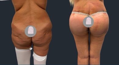 Before and after Brazilian Butt Lift results at Dr. MED – enhanced buttock shape and contour