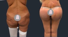 Before and after Brazilian Butt Lift results at Dr. MED – enhanced buttock shape and contour
