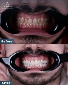 Before and after veneers results at Dentavie Istanbul Dental Clinic, smile transformation