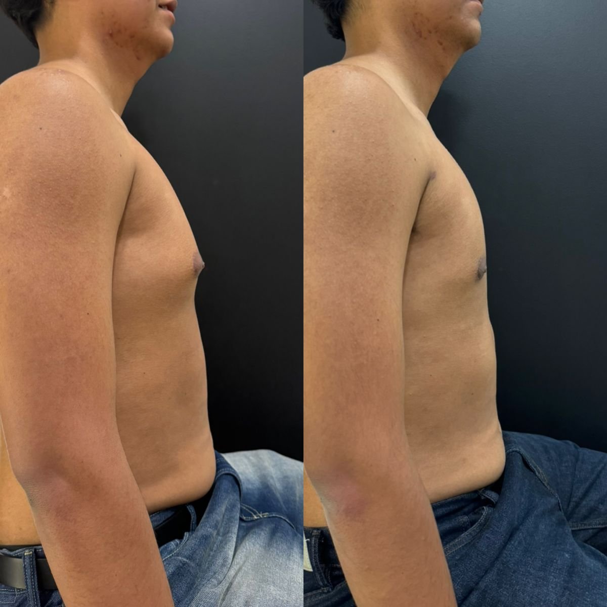 Before and after gynecomastia surgery results at Dr. Alexandro Aguilera - Plastic Surgery