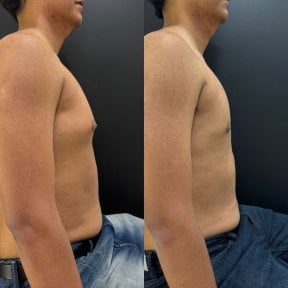 Результаты до и после операции гинекомастии в Dr. Alexandro Aguilera - Plastic Surgery