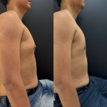 Результаты до и после операции гинекомастии в Dr. Alexandro Aguilera - Plastic Surgery