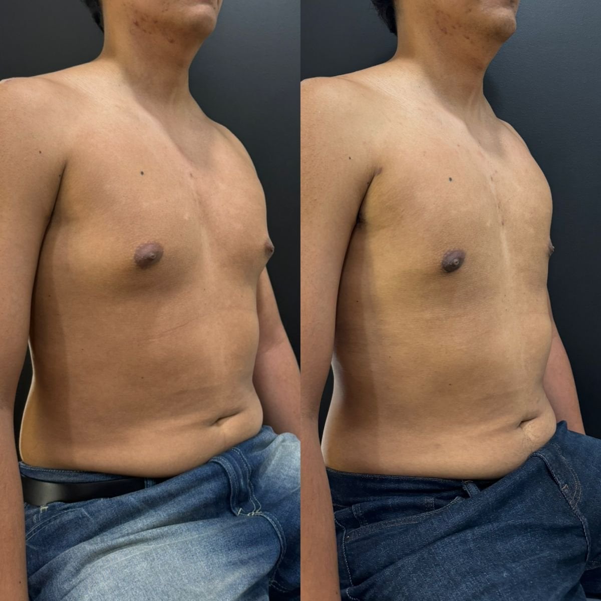 نتائج قبل وبعد جراحة التثدي في عيادة Dr. Alexandro Aguilera - Plastic Surgery