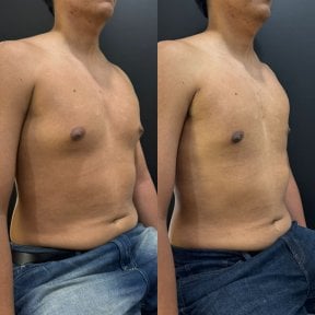 Результаты до и после операции гинекомастии в клинике Dr. Alexandro Aguilera - Plastic Surgery