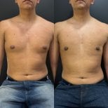 Результаты до и после операции гинекомастии в клинике Dr. Alexandro Aguilera - Plastic Surgery
