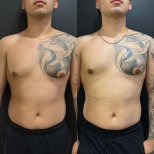 Результаты до и после операции гинекомастии в Dr. Alexandro Aguilera - Plastic Surgery