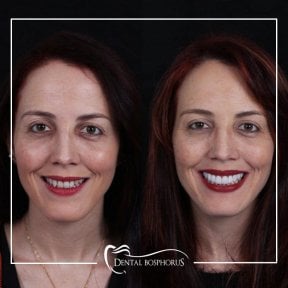 Результати до і після Hollywood Smile у Dental Bosphorus, перетворення білої посмішки
