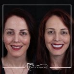 Результати до і після Hollywood Smile у Dental Bosphorus, перетворення білої посмішки
