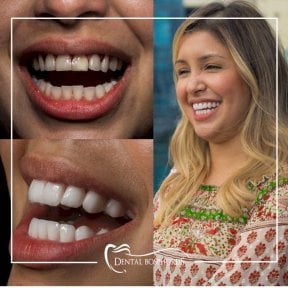 Résultats avant/après Hollywood Smile chez Dental Bosphorus, transformation par facettes blanches