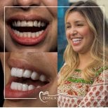 Résultats avant/après Hollywood Smile chez Dental Bosphorus, transformation par facettes blanches